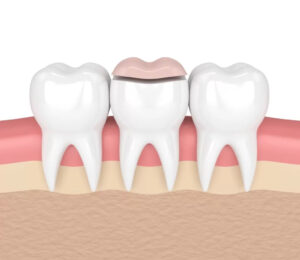3d rendering of a dental inlay being applied