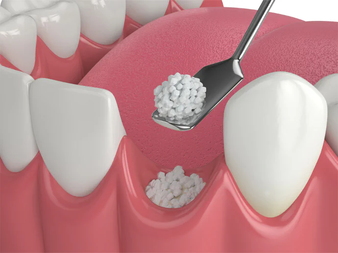 Dental bone grafting in Oak Lawn, IL at Roots Dental Studio.