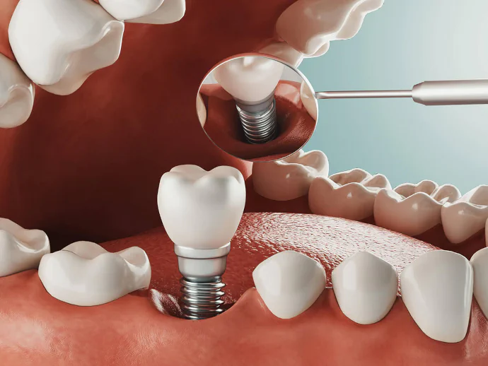 Dental implants in Oak Lawn, IL at Roots Dental Studio.
