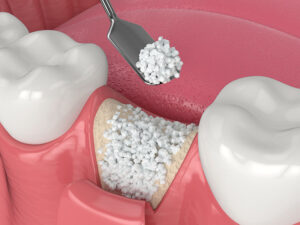 The image shows a dental procedure where bone graft material is being placed into a tooth socket. The small white granules of bone graft material are being applied using a dental tool.