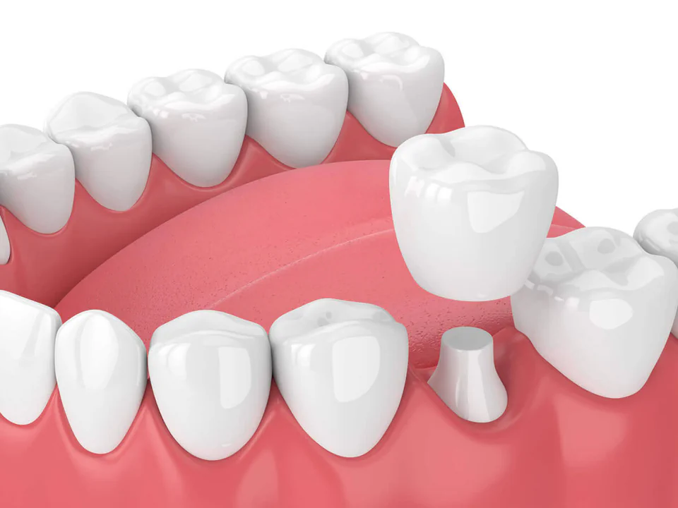 Dental crowns and dental bridges in Oak Lawn, IL at Roots Dental Studio.