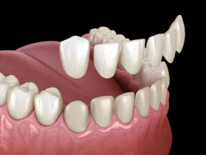 A 3D illustration of a dental procedure showing the placement of dental veneers on the upper front teeth. The image depicts the veneers being positioned over the natural teeth, highlighting the process of cosmetic dental enhancement.