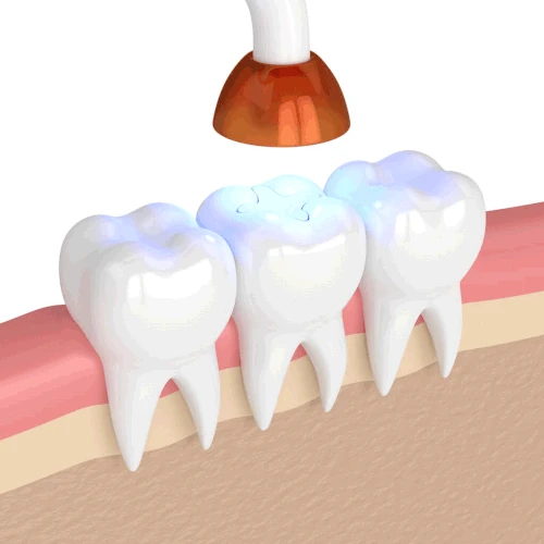 Dental fillings and dental sealants in Oak Lawn, IL at Roots Dental Studio.