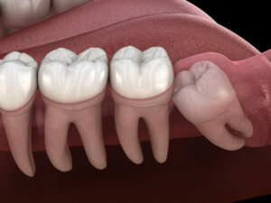 A 3D rendering of a section of a mouth, showcasing the molars and an impacted wisdom tooth. The first three teeth on the left are healthy molars, while the fourth tooth on the right is the impacted wisdom tooth, growing at an angle and pressing against the adjacent molar.