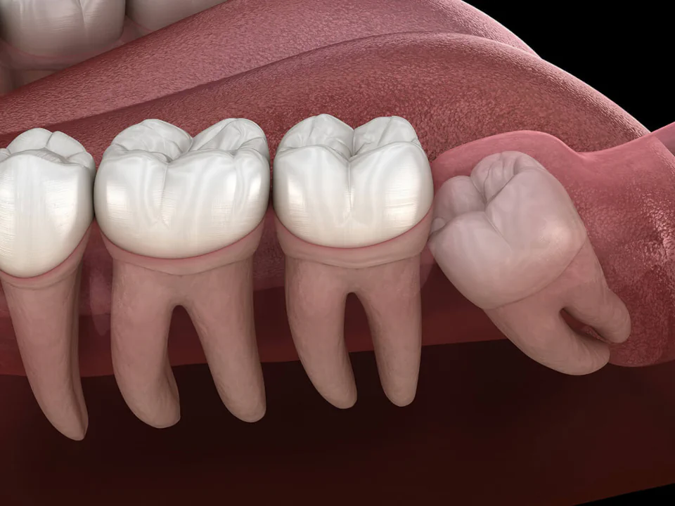 Wisdom teeth removal in Oak Lawn, IL at Roots Dental Studio.
