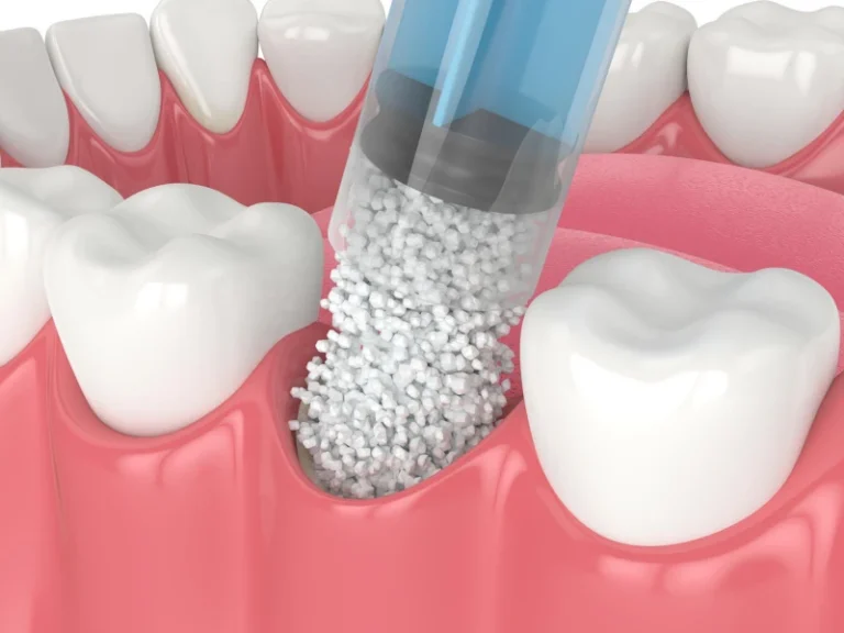When Is a Bone Graft Necessary?